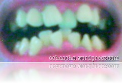 orthodontic-brace